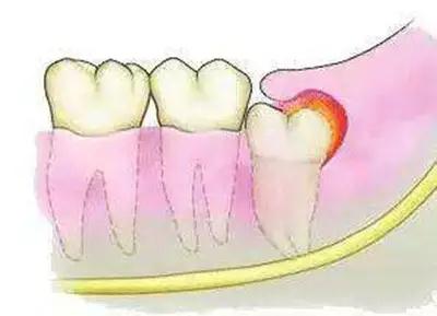 长智齿时需注意什么防止智齿长歪,有什么办法避免长智齿