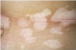 情绪不好出现皮肤病,情绪不稳定得皮肤病