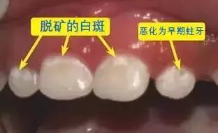 牙齿脱钙可以治愈吗,牙齿脱钙最佳补救方法