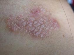 情绪不好出现皮肤病,情绪不稳定得皮肤病