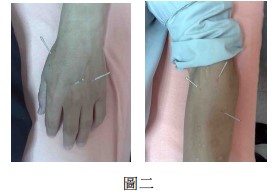 屈指肌腱鞘炎病历,屈指肌腱鞘炎