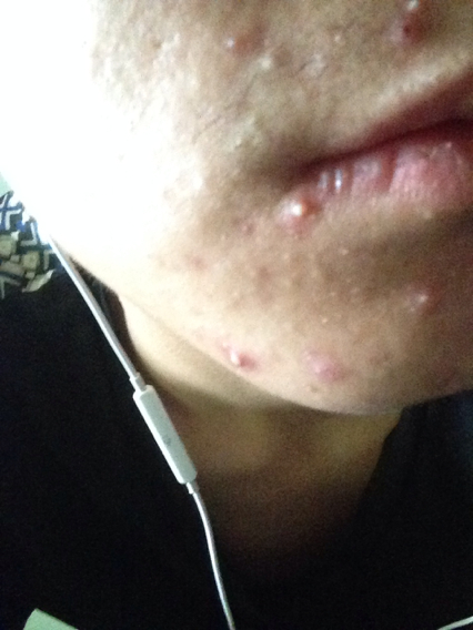 怀孕了嘴周围长痘痘怎么回事,嘴周围长痘痘应该用什么药