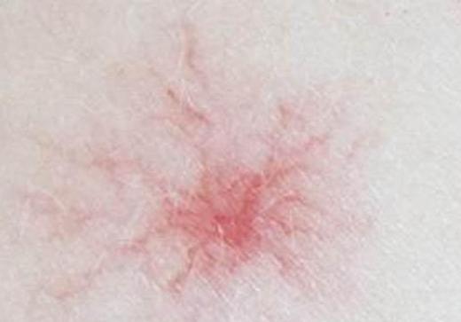 身上有小红痣不痛不痒是怎么回事,人到中年身上长小红痣是什么原因