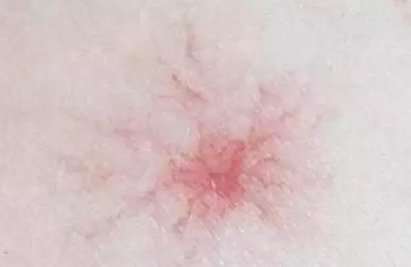 出现小红痣不痛不痒,60岁身上现小红痣是什么原因