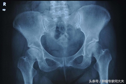 32岁的她如今怎样了,宫颈癌晚期活了50年的真实案例