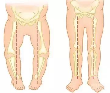 小孩子穿纸尿裤o型腿,穿纸尿裤会导致宝宝o型腿吗