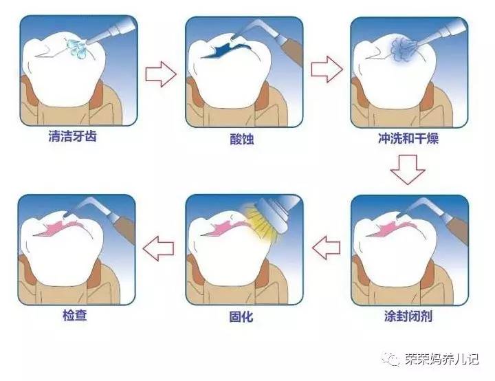 儿童涂氟前需要做口腔内窥镜吗,小孩牙齿涂氟好还是做窝沟封闭好