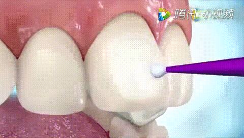 全瓷牙套怎么才算安装好,牙齿矫正有几种牙套图片