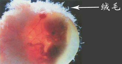 孕妈妈有没有做过绒毛穿刺检查？