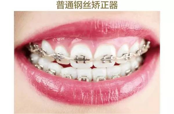 牙整形需要什么过程,整形整牙全过程