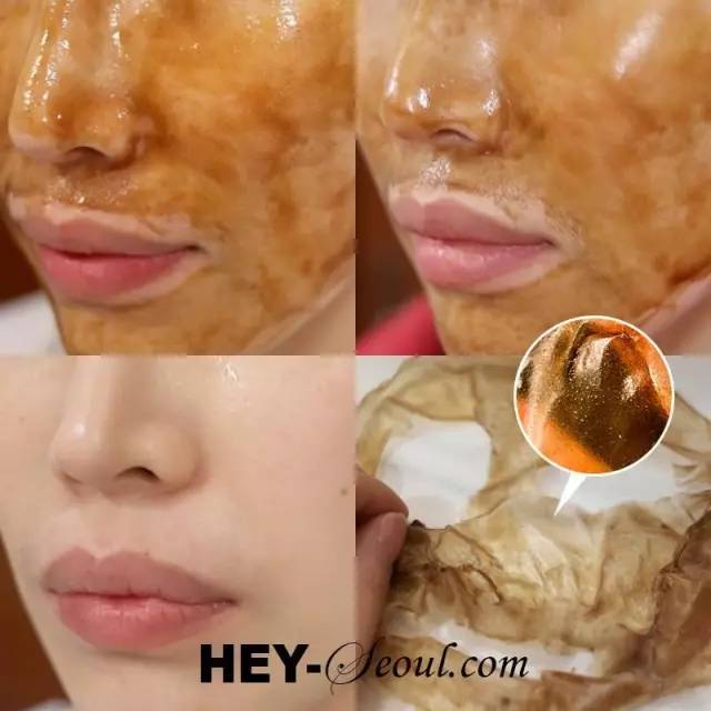 粉刺黑头去除最快方法,黑头虫怎么去除最快方法