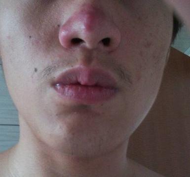 脸色变黑是肝还是肾的问题,脸色变黑一定是肝硬化吗