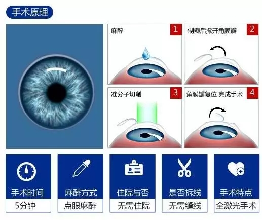 近视手术什么感觉,近视手术到底什么感觉