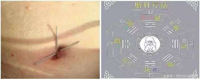 尿路堵塞为什么在腰部插管,尿路梗阻需要动手术么