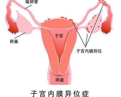备孕痛经,女性备孕期间痛经怎么办