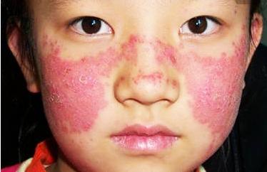 红斑狼疮临床表现记忆口诀,红斑狼疮记忆能恢复吗