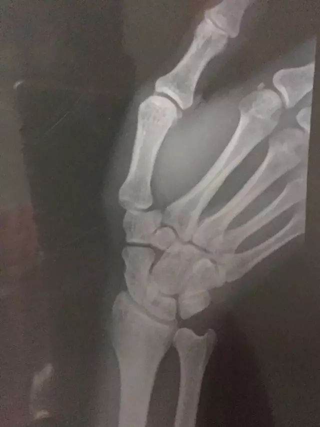 网球肘详细讲解,如何发力避免网球肘