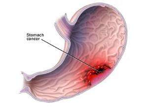 浅表性胃炎伴糜烂中医治疗方法,慢性浅表性胃炎中医好还是西医好