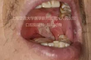 口腔溃疡太疼怎么上药,口腔溃疡很痛怎么办吃什么好得快