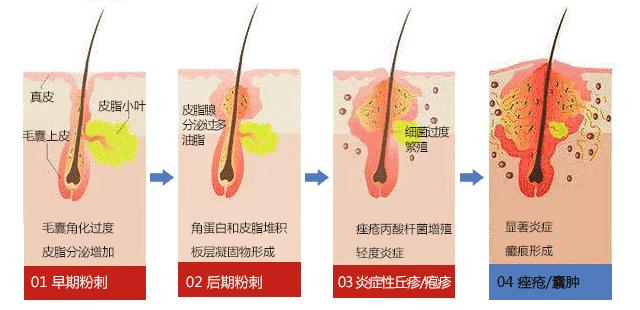 痘痘闭口摸起来还有点疼痛,痘痘闭口反反复复怎么办