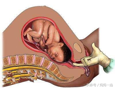 顺产就像断了18根肋骨,顺产真的是20根肋骨同时断裂吗