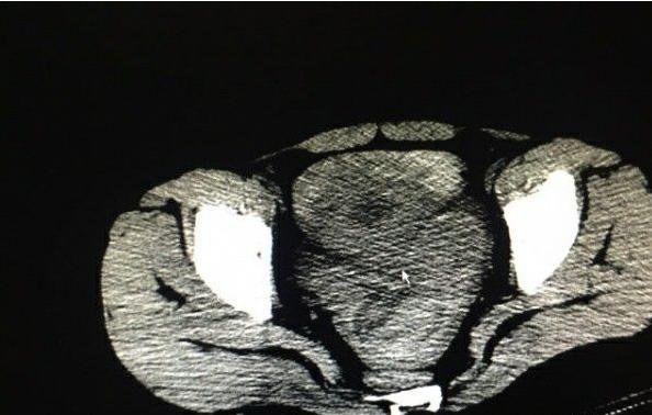 女子腹痛查出宫内宫外,女子腹痛去医院医生一看立马报警