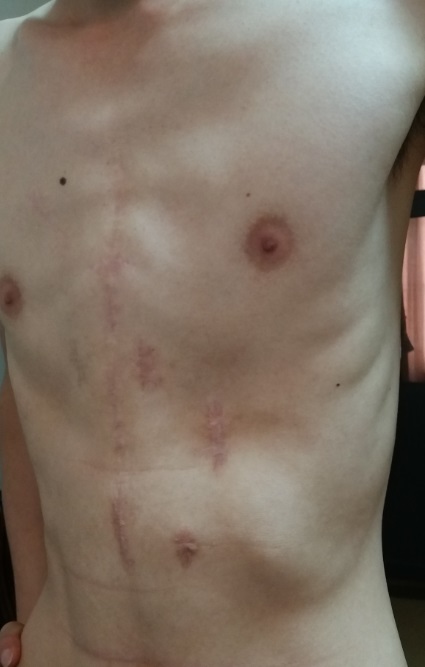 鸡胸手术恢复过程痛苦吗,鸡胸22岁手术还有效果吗