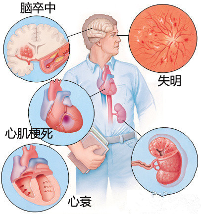 普利和沙坦哪个对肾更好,普利和沙坦类降压药能搭配使用吗