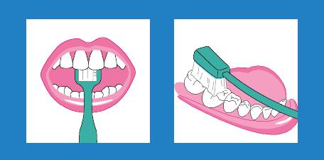 2岁宝宝牙齿龋齿很严重怎么办,大人帮着孩子刷牙还是龋齿怎么办