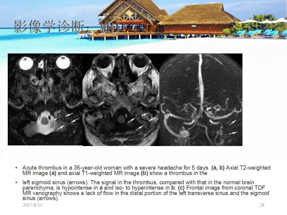颅内静脉窦血栓形成怎么治疗,颅内静脉窦血栓形成最佳治疗方法