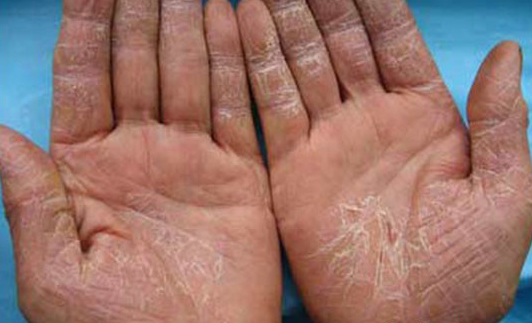 患了湿疹怎么办教你一招简单高效,湿疹怎么办最有效小方法