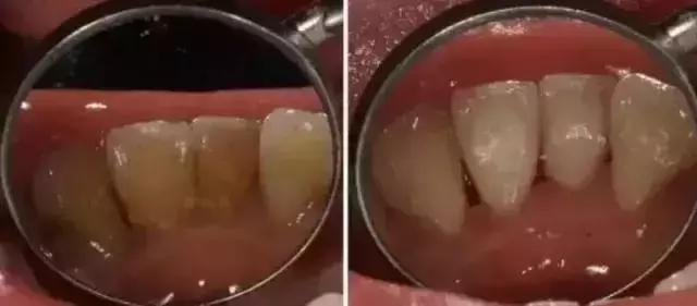 牙齿松动咬不动硬的菜怎么回事,牙齿咬硬物后松动是怎么回事