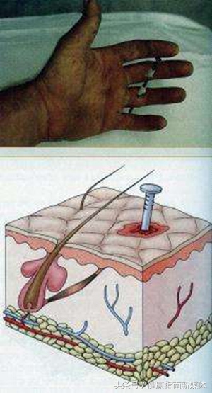 不小心踩到铁钉了怎么办,踩了锈钉子打了破伤风就没事了吗