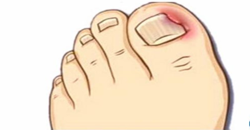 如何解决脚趾甲长进肉里,脚趾甲长进肉怎么治