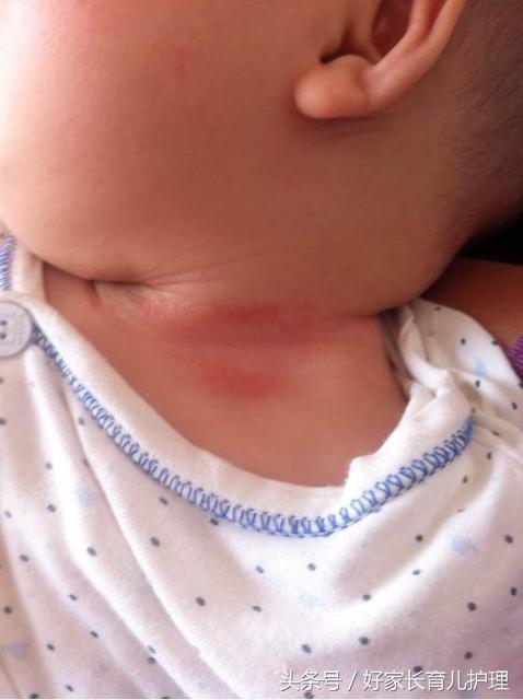 宝宝淹脖子了正确处理方法,一招搞定宝宝淹脖子