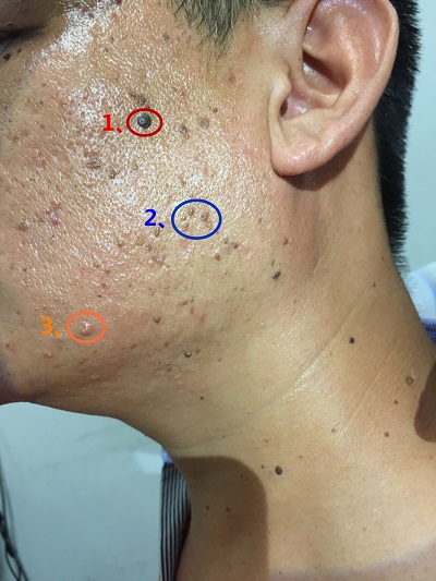 都是痘痘痘印怎么办,都是痘痘怎么办