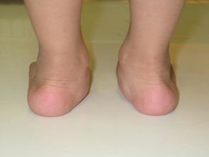 脚拇指骨外翻怎么治,脚拇指外翻怎么矫正