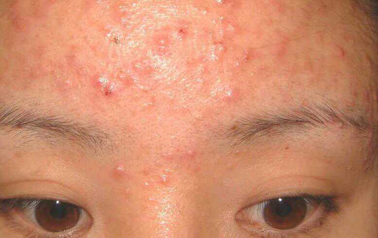 脸上毛孔里挤出白色条状是螨虫吗,脸上长螨虫的表现你中招了吗