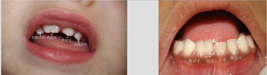 双牙重叠,连着两颗牙齿松动怎么办