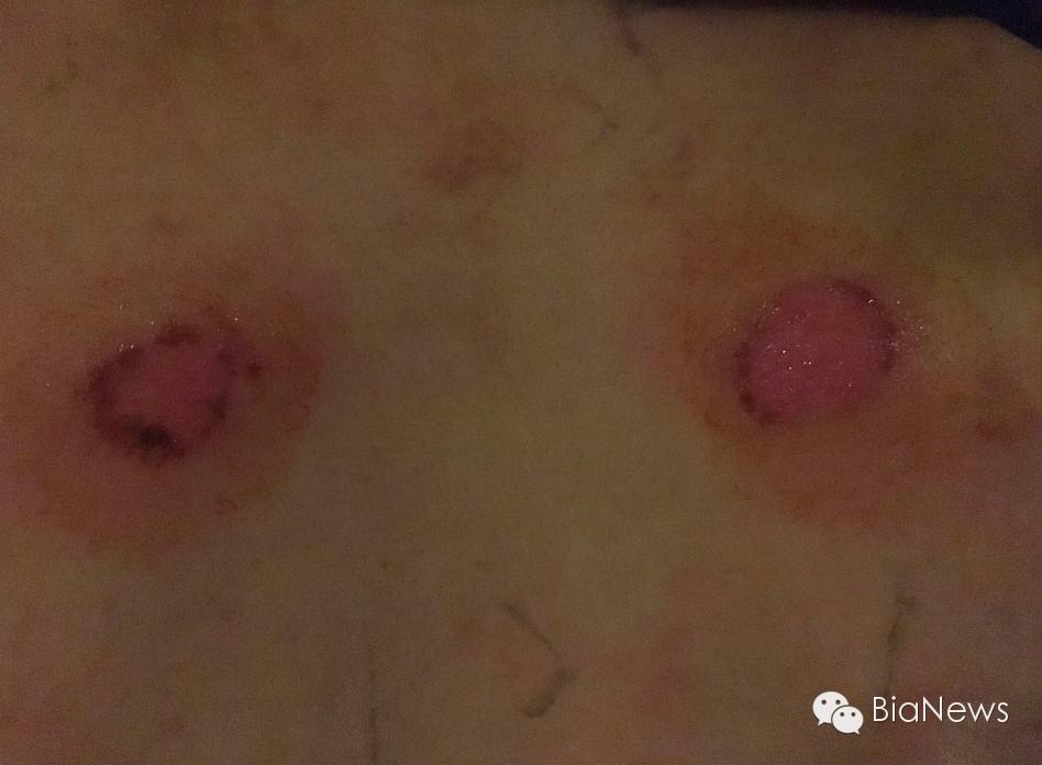 刮痧刮破皮了可要求多少赔偿,刮痧刮掉皮了