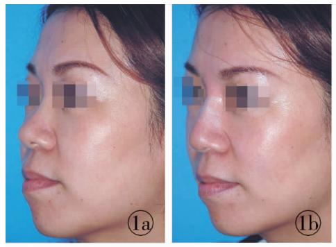 隆鼻选对方法很重要效果美到爆,单纯隆鼻和综合隆鼻该如何来选择