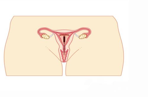 节育环有哪些注意事项？医生给出三点建议！