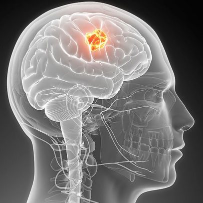 2017年国际癌症科学取得三项突破