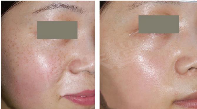 激光祛斑后怎么避免黑色素,激光祛斑后黑印子多久消失