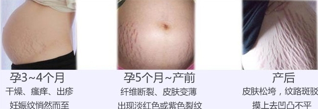 怀孕大肚子长妊娠纹抹橄榄油,怀孕后长妊娠纹怎么处理