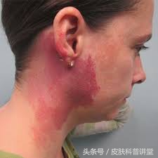 冷冻可以治疗鲜红斑痣胎记吗,治疗鲜红斑痣胎记的方法有哪些