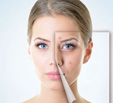 30天祛痘痘最好的方法,抗痘与祛痘的区别