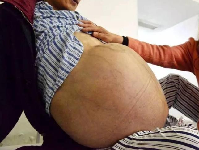 便秘折磨15年,吃不下,拉不出!原来肚里长个10斤大“皮球”