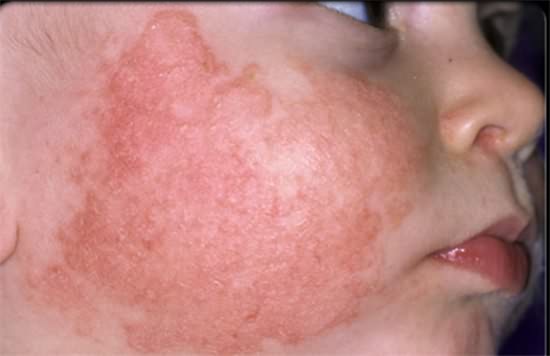 宝宝湿疹样皮炎怎么引起来的,宝宝皮炎性湿疹怎么治疗