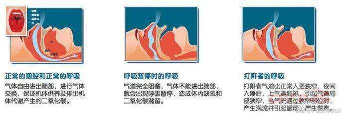小孩打呼噜张口呼吸按什么穴位,检测打呼噜原因穴位贴哪个部位
